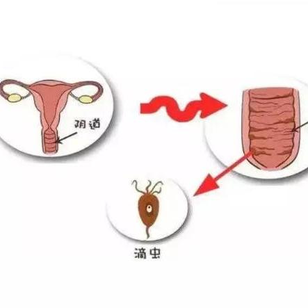 女性阴道炎的主要症状表现指哪些？泰安俪人医院来讲解