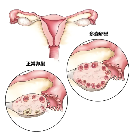多囊卵巢的症状表现体现在哪几个方面？