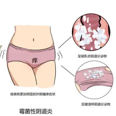 泰安俪人医院介绍女性患有阴道炎后要如何处理
