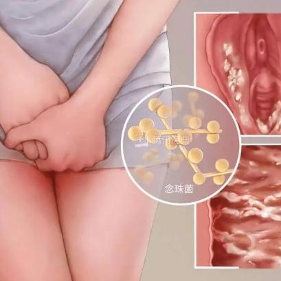 女性患有阴道炎后会有哪些症状表现呢？