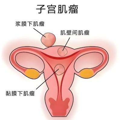 女性子宫肌瘤的症状表现主要有哪些？