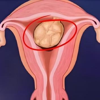 子宫肌瘤的症状表现有哪些？这些得重点关注下