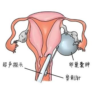 女性出现卵巢囊肿的危害表现有哪些？