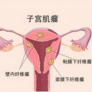 哪些原因引发女性子宫肌瘤？这几项是主要原因