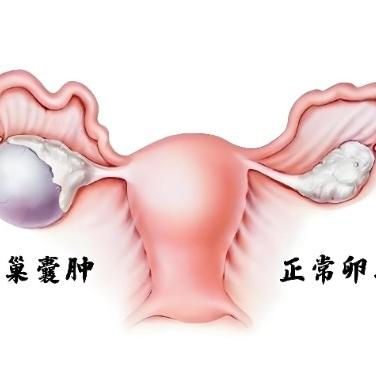 怎样知道自己患有卵巢囊肿？症状表现是什么