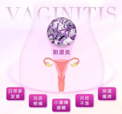泰安俪人医院讲解女性阴道炎的症状表现具体是什么