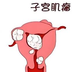 子宫肌瘤的早期症状与具体表现有哪些？